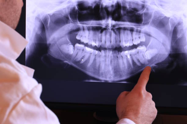 Best Emergency Wisdom Teeth Removal in Athens, TX
